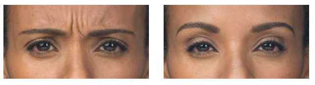 injectable before and after