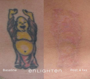 Buddha tattoo before and after removal