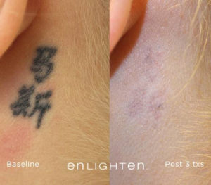 Tattoo on womans neck behind ear before and after removal