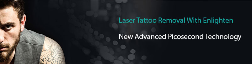 Laser Tattoo Removal Olympia WA | Tacoma | Lakewood | Puyallup | Lacey