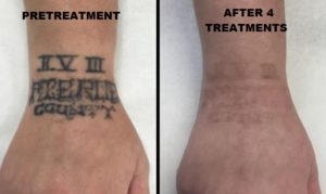 Tattoo on male wrist before and after laser tattoo removal treatment