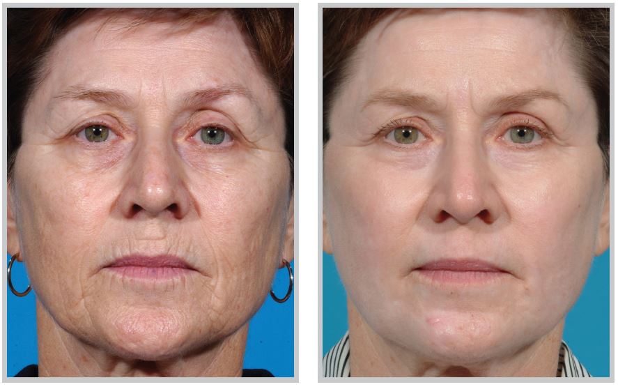 erbium laser resurfacing near me