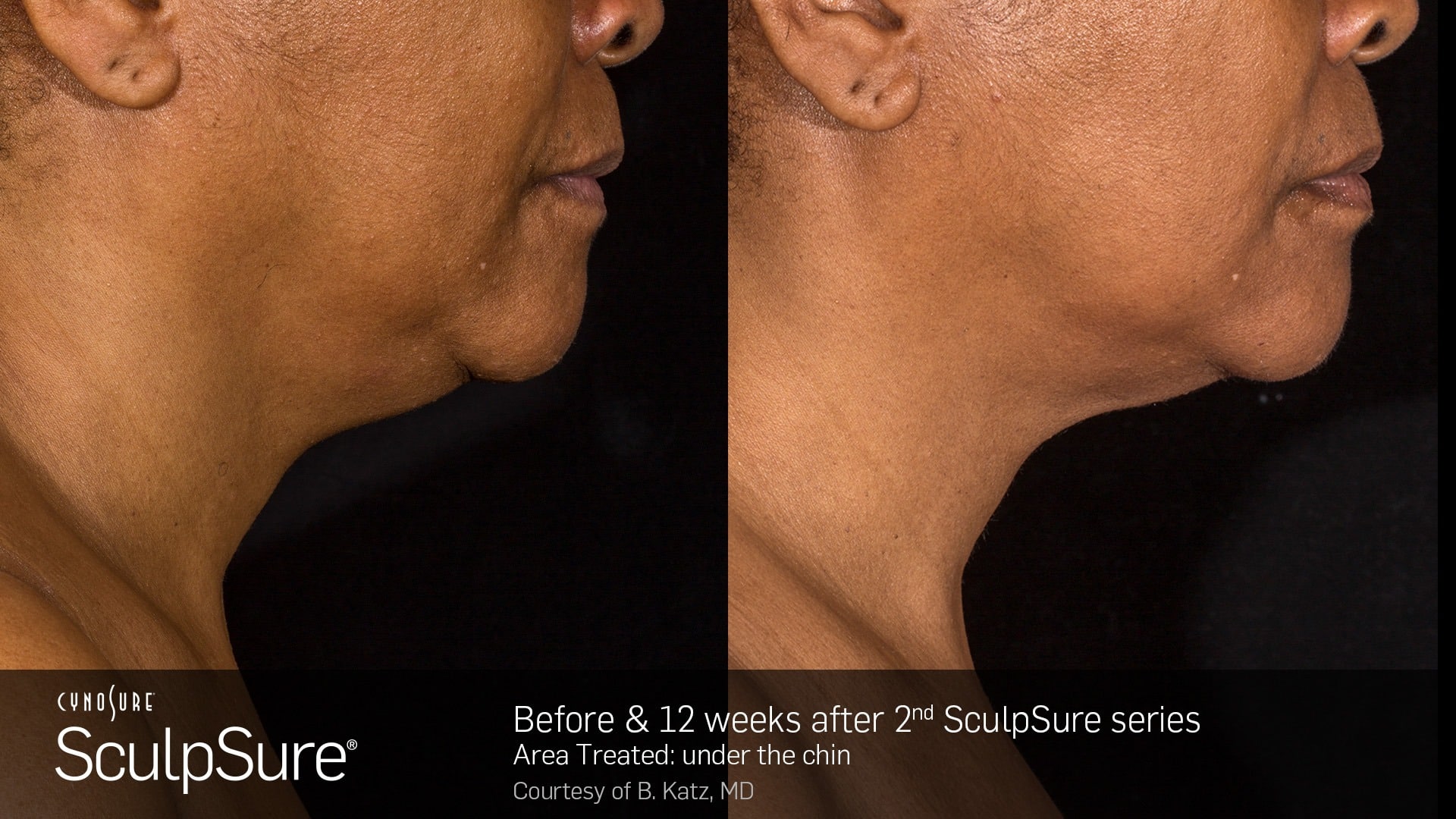 Sculpsure submental B and A
