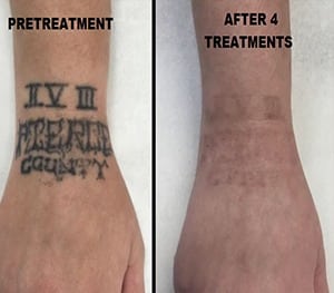 Tattoo removal olympia