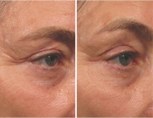 Ulthera brows before and after 1