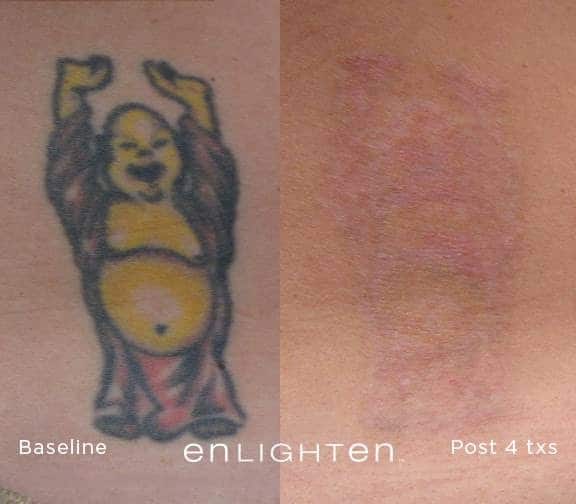 tattoo removal1