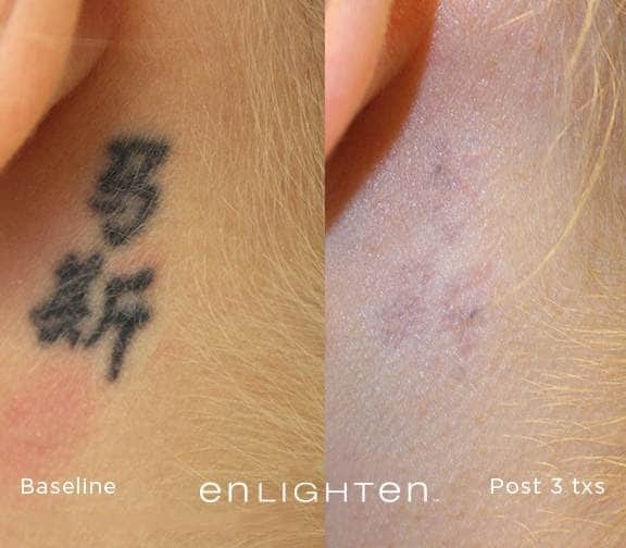 tattoo removal2