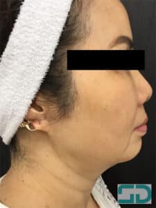 Before Image: Radiesse