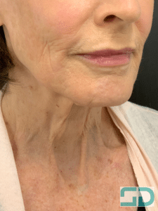 After Image: Revanesse Lips+ to Augment Lips and Xeomin