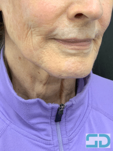 Before Image: Revanesse Lips+ to Augment Lips and Xeomin