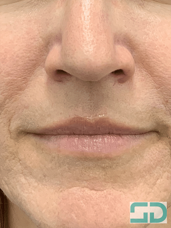 After Image: Excel V Spot Treatment - front
