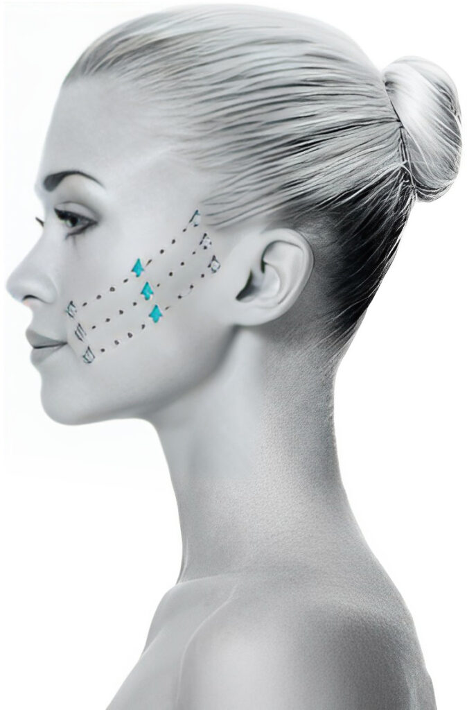 Silhouette Instalift Non Surgical Facial Rejuvenation WA