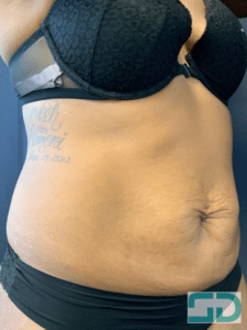 After Image: Coolsculpting