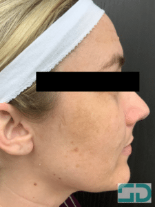 After Image: BBL and Hydrafacial series