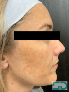 Before Image: BBL and Hydrafacial series
