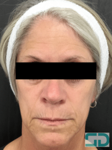 Before Image: Filler and Neurotoxin