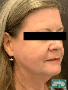 After Image: TCA Peel