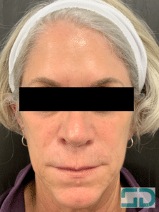 After Image: Filler and Neurotoxin
