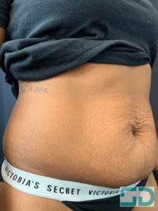 Before Image: Coolsculpting