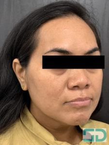 Before Image: Xeomin and Revanesse Versa+