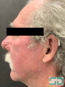 After Image: Laser Genesis and Excel V
