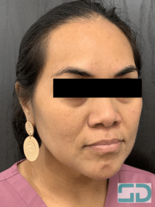 After Image: Xeomin and Revanesse Versa+