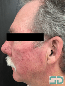 Before Image: Laser Genesis and Excel V