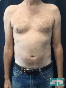 After Image: Coolsculpting