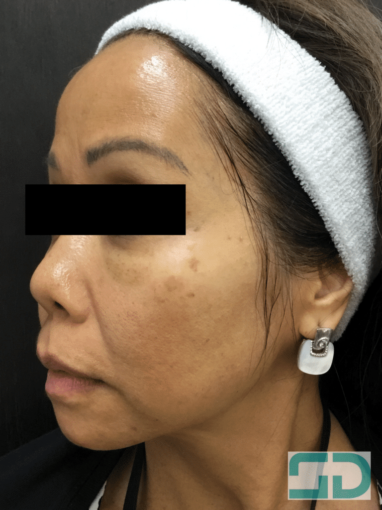 Before Image: Pico Genesis - left-front-oblique