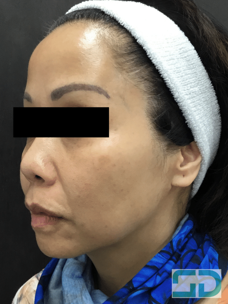After Image: Pico Genesis - left-front-oblique