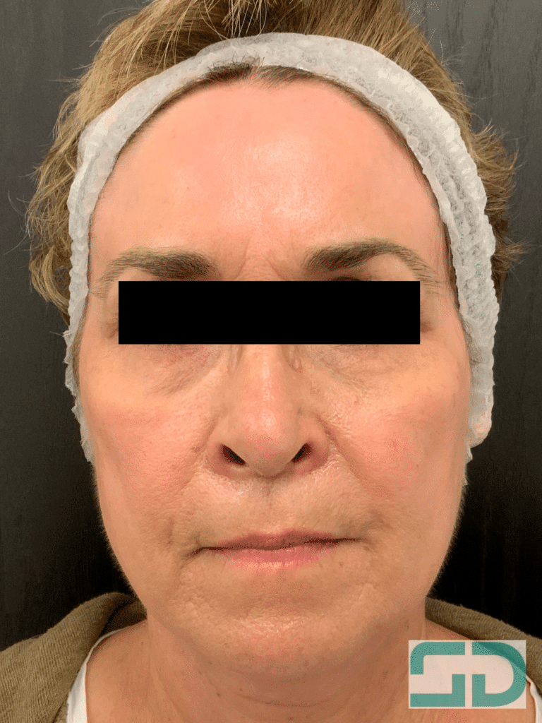 After Image: TCA Peel - front