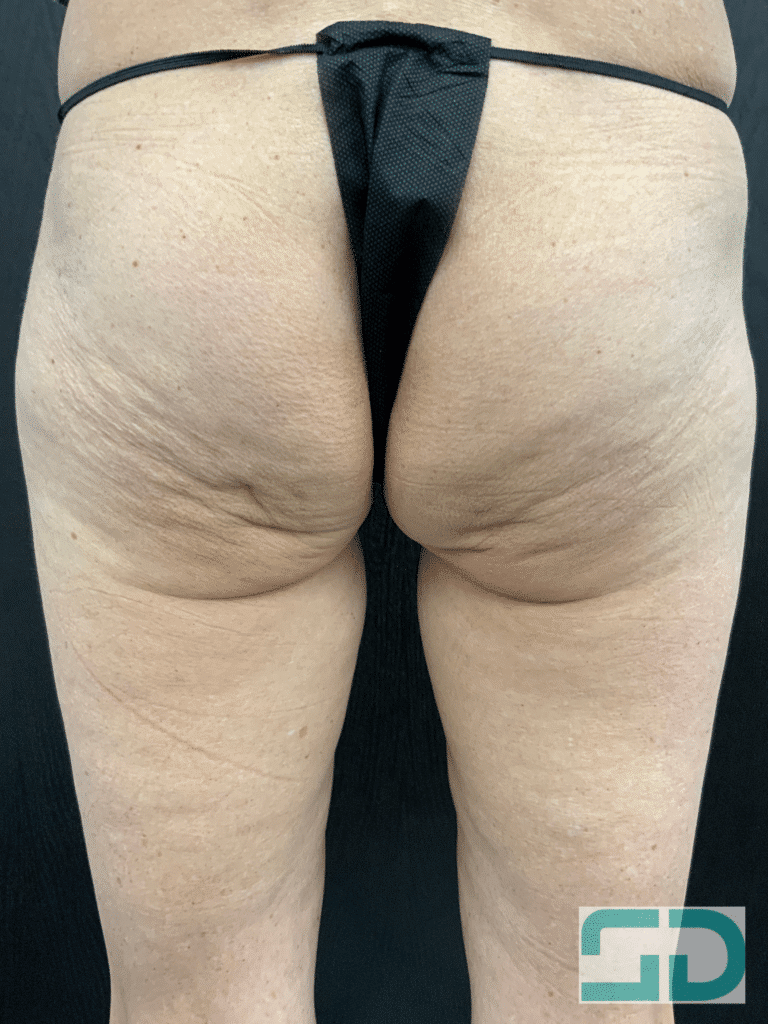 Before Image: Sculptra - back