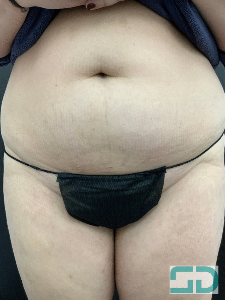 After Image: Excel V - front